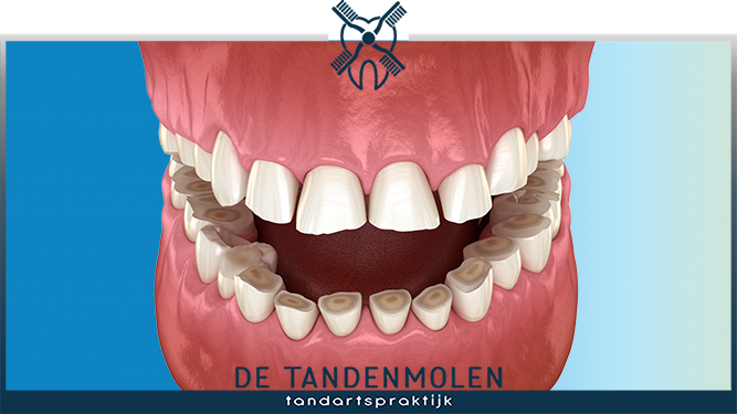 Erosie De Tandenmolen
